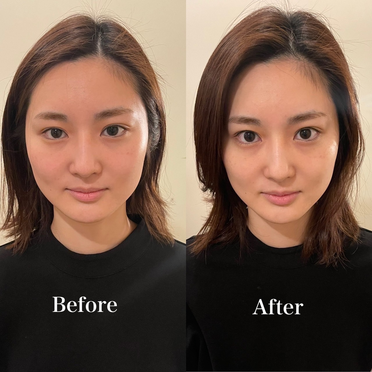 美容鍼と整体を6回受けたモニターの方の施術前後の顔写真（女性）