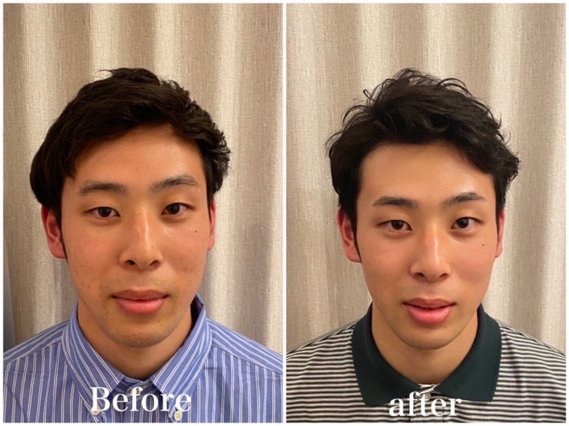 美容鍼と整体を6回受けたモニターの方の施術前後の顔写真（男性）